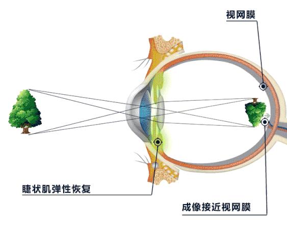 美国最新近视技术，重塑视觉世界的希望之光